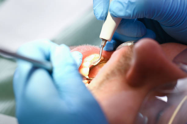 Best Emergency Treatment for Dental Infections or Abscesses in Citrus Hills, FL
