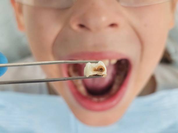Best Emergency Dental Care for Broken or Chipped Teeth in Citrus Hills, FL